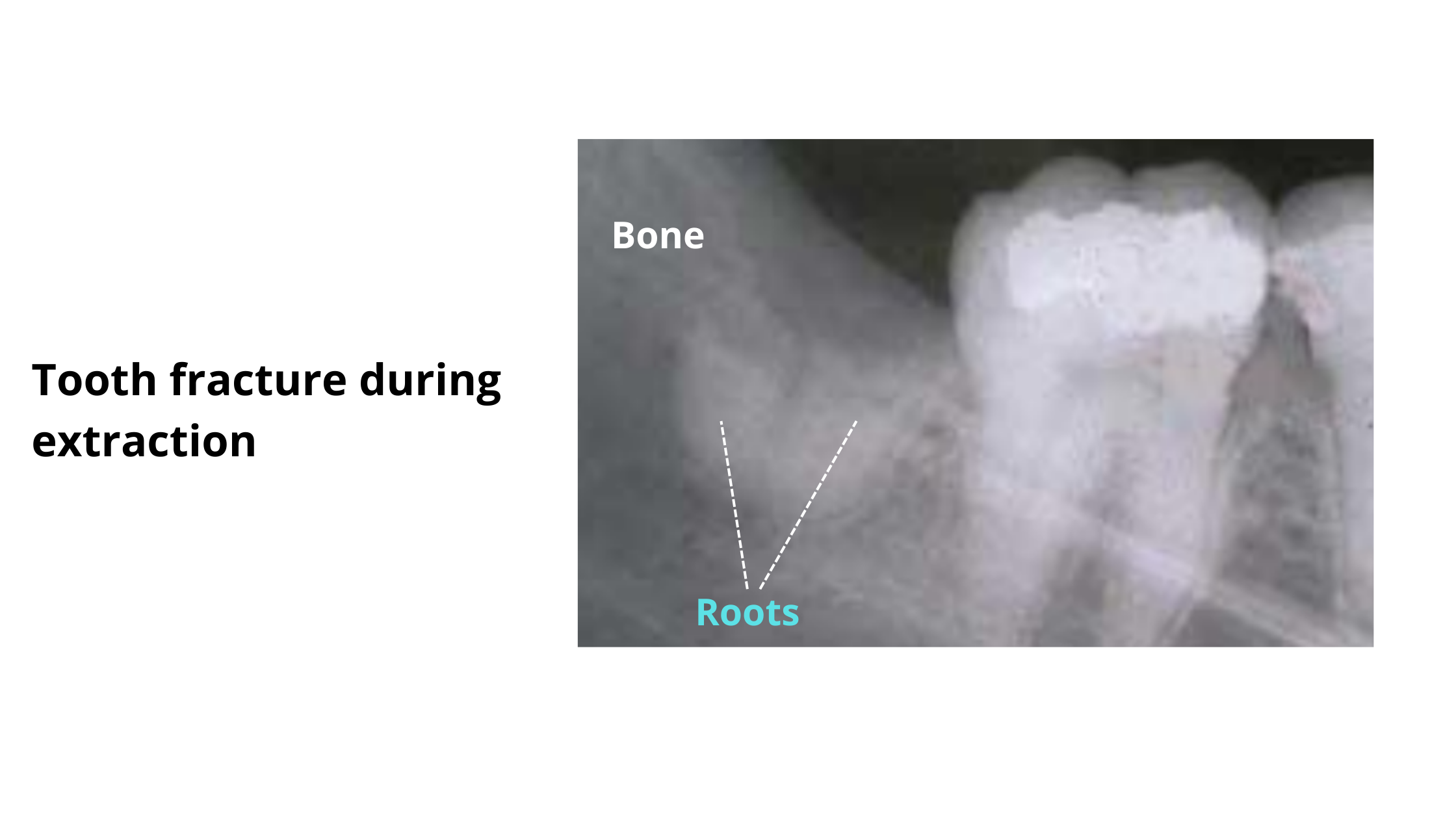 Dental X-ray showing root fracture of an extracted tooth